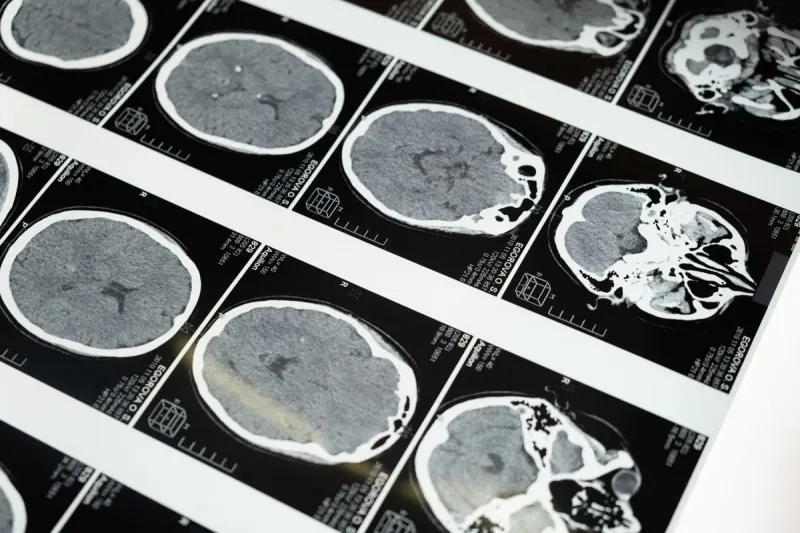 Neuromodulation Devices That Improve Sleep Quality Are Expected To Become Commercial. Neuromodulation Devices That Improve Sleep Quality Are Expected To Become Commercial.